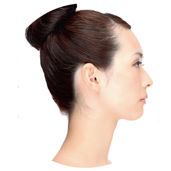 Approaches to Rhinoplasty