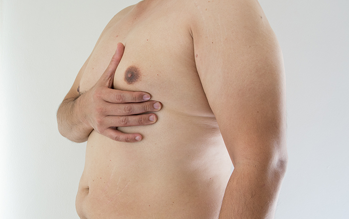 Understanding Gynaecomastia