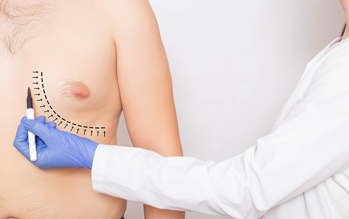 What You Need to Know About Gynaecomastia Surgery (Male Breast Reduction)