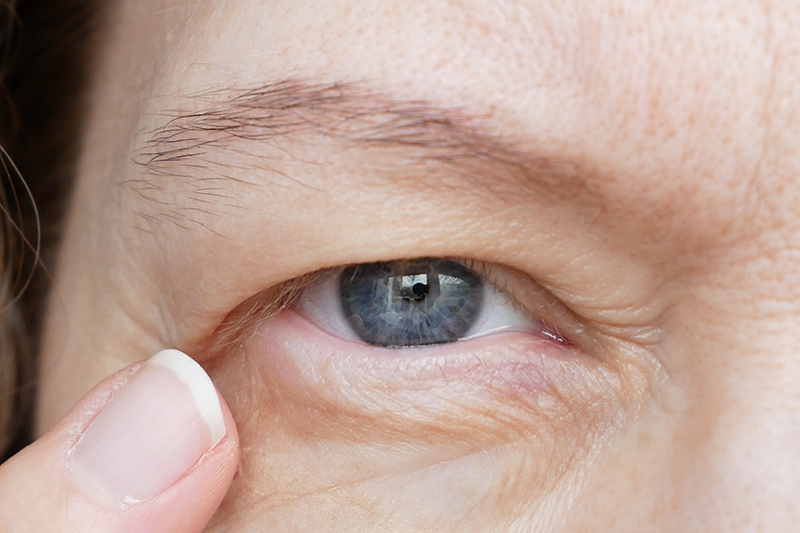 Woman with a visibly droopy upper eyelid