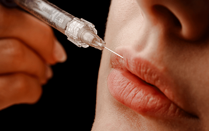 Lip Augmentation