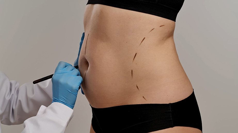 Woman undergoing pre-procedure preparation for liposuction and body contouring
