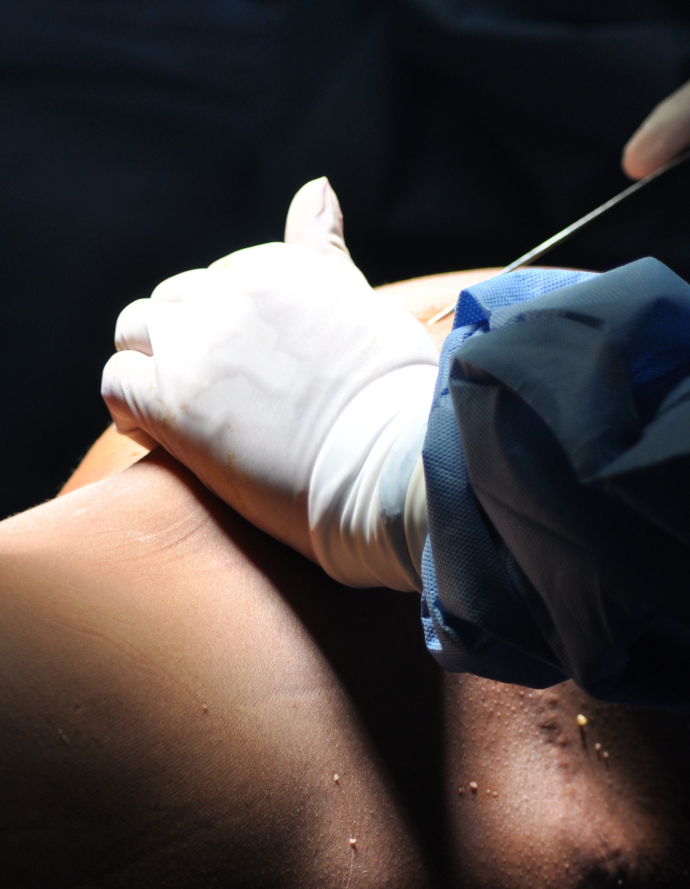 What is Liposuction?